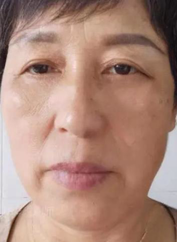 去眼袋手术