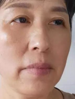 去眼袋手术
