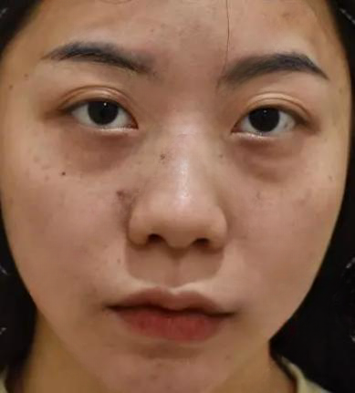 去眼袋手术