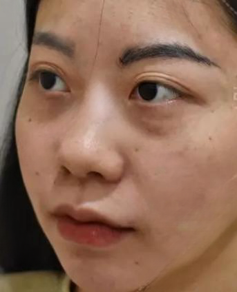 去眼袋手术