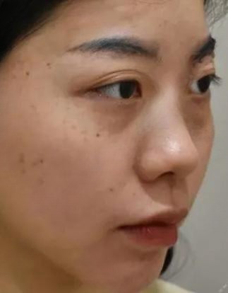 去眼袋手术