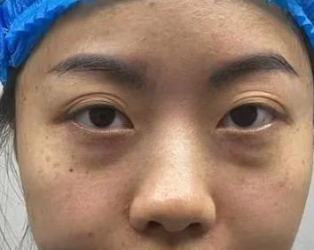 去眼袋手术