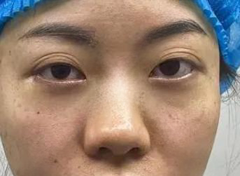去眼袋手术