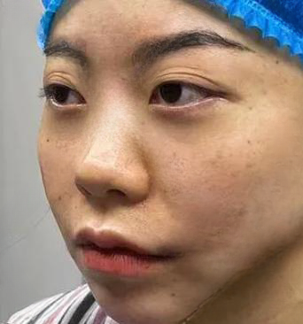 去眼袋手术