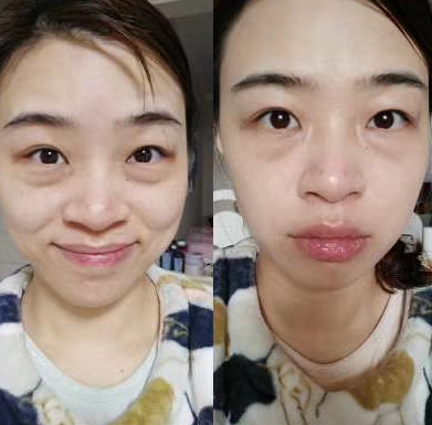 去眼袋手术