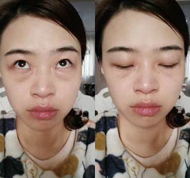 去眼袋手术