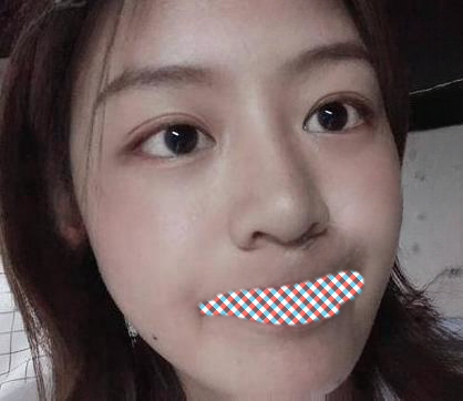 去眼袋手术