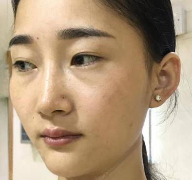 自体脂肪胶
