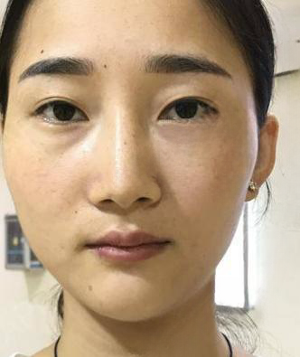 自体脂肪胶
