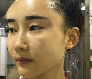 自体脂肪胶