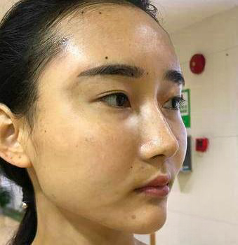 自体脂肪胶