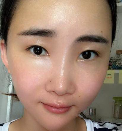 自体脂肪胶