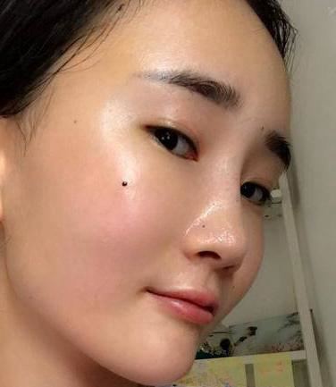 自体脂肪胶