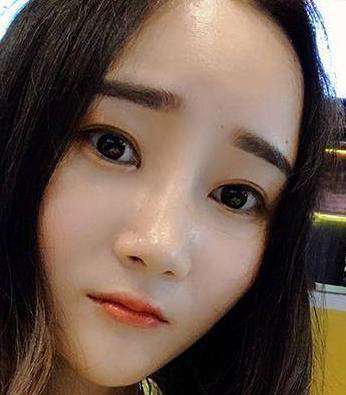 自体脂肪胶