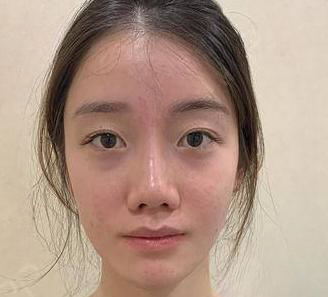 自体脂肪胶