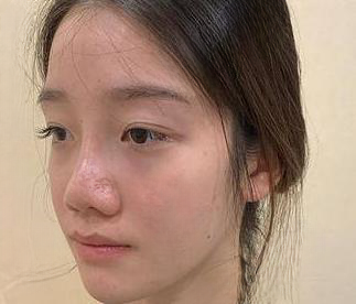 自体脂肪胶