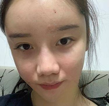 自体脂肪胶