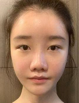自体脂肪胶