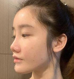 自体脂肪胶