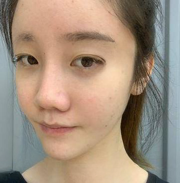 自体脂肪胶