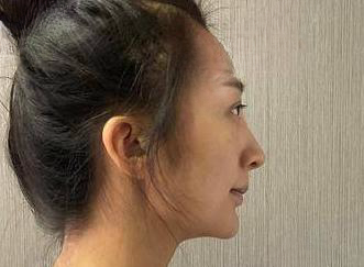 自体脂肪胶