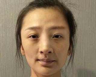 自体脂肪胶