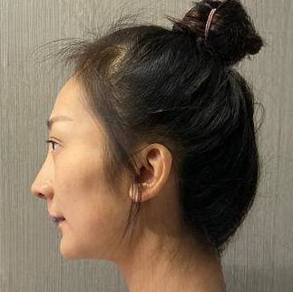 自体脂肪胶