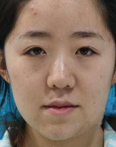 自体脂肪胶