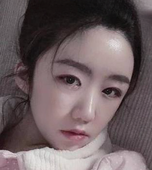 自体脂肪胶