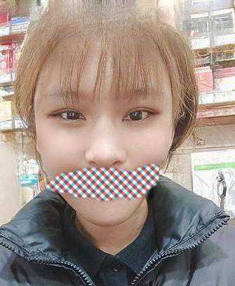 自体脂肪胶