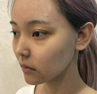 自体脂肪胶