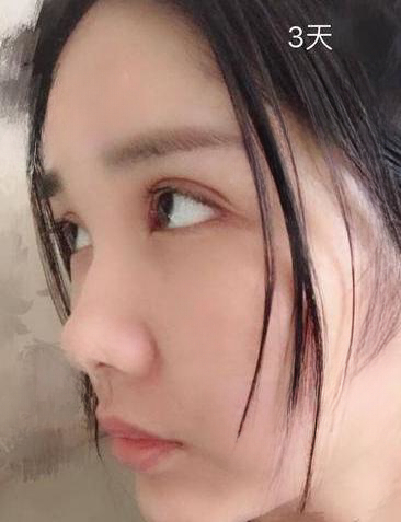 自体脂肪胶