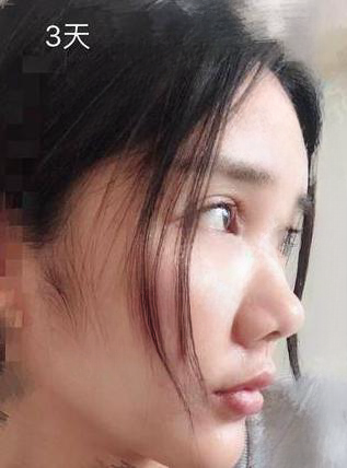 自体脂肪胶
