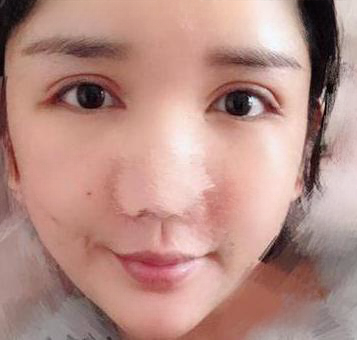 自体脂肪胶