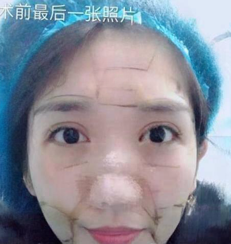 自体脂肪胶