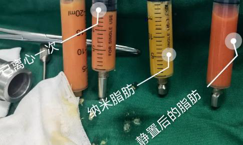 自体脂肪胶