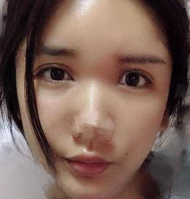 自体脂肪胶
