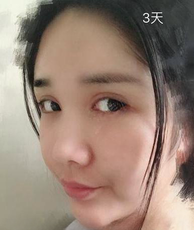 自体脂肪胶