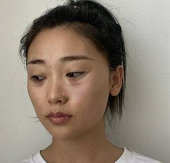 去眼袋手术