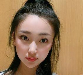 去眼袋手术