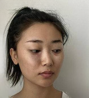 去眼袋手术