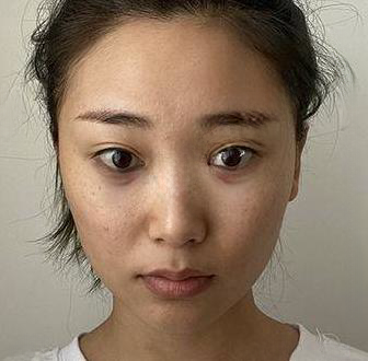 去眼袋手术