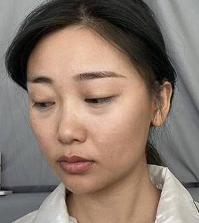 去眼袋手术