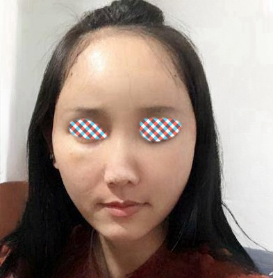 自体脂肪胶