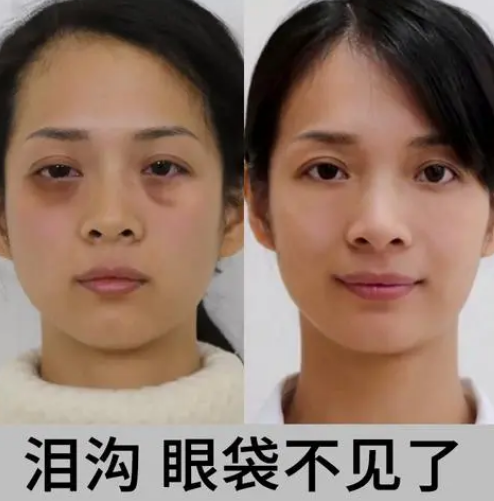 去眼袋手术