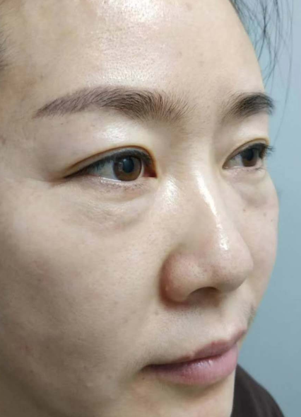 去眼袋手术