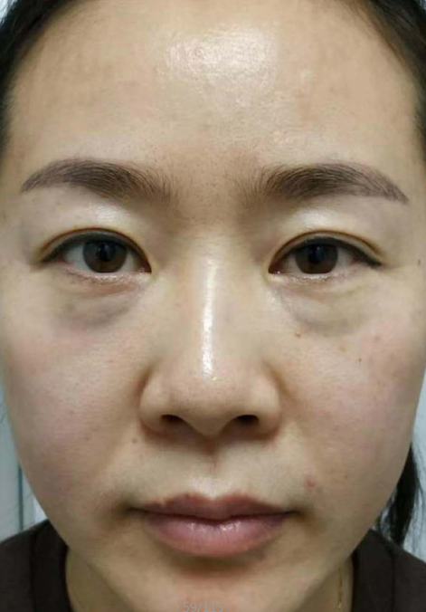 去眼袋手术