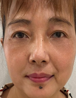 去眼袋手术