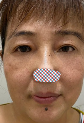 去眼袋手术