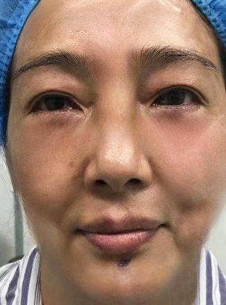 去眼袋手术